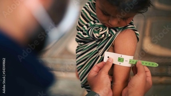 Fototapeta A doctor examines children's malnutrition inside a refugee camp. Malnutrition was measured using a mid-upper arm circumference belt. 
