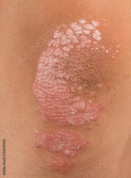 Obraz psoriasis