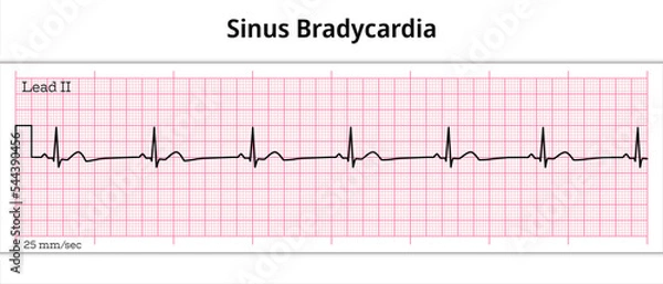 Fototapeta ECG Sinus Bradycardia - 8 Second ECG Paper