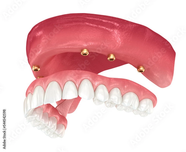 Fototapeta Maxillary prosthesis with gum All on 6 system supported by implants. Dental 3D illustration