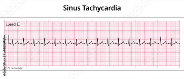 Fototapeta ECG Sinus Tachycardia - 8 Second ECG Paper 