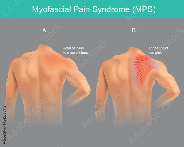 Fototapeta Trigger points Pain Syndrome. The back chronic pain disorder in a human shoulder area. Illustration infographic..