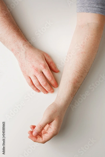 Fototapeta Male hands on white table with red spots on skin. Allergic reaction, skin problems, dermatology. Wrong diet, side effect from taking meds