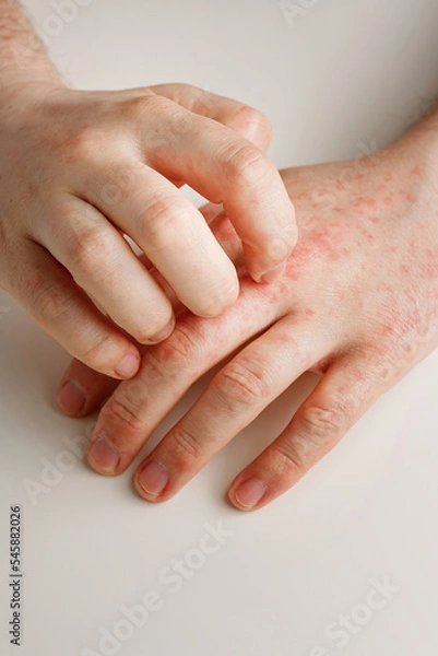 Fototapeta Male hands scratching itchy red spots on skin. Allergy reaction from wrong diet, by-effect from taking antibiotics or medicines. Skin disease