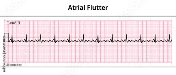 Fototapeta ECG Atrial Flutter - 8 Second ECG Paper