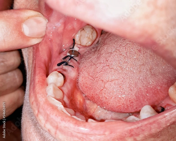 Fototapeta Close-up of a gum after surgery. Post operative tooth extraction with stitches. Concept of dental implant and preparation for surgery.