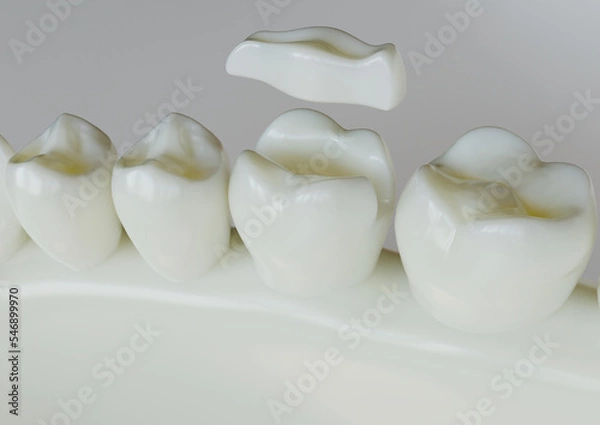 Obraz Ceramic Inlay crown over a tooth- 3D Rendering