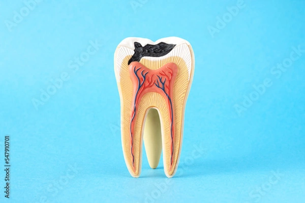 Fototapeta Close-up internal tooth structure model with fisrt step of caries decay  on blue background