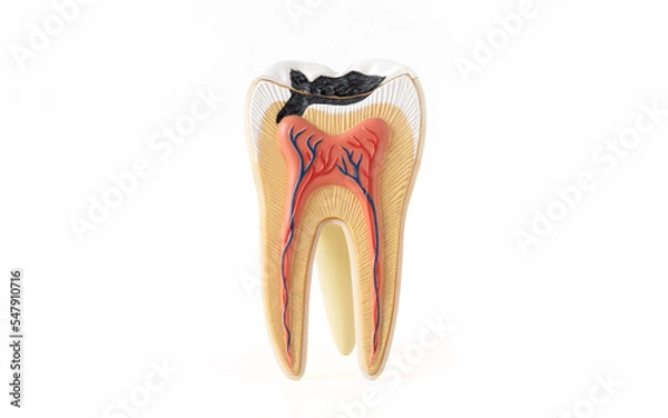 Fototapeta Isolated photo of internal tooth structure model with caries destruction on white background