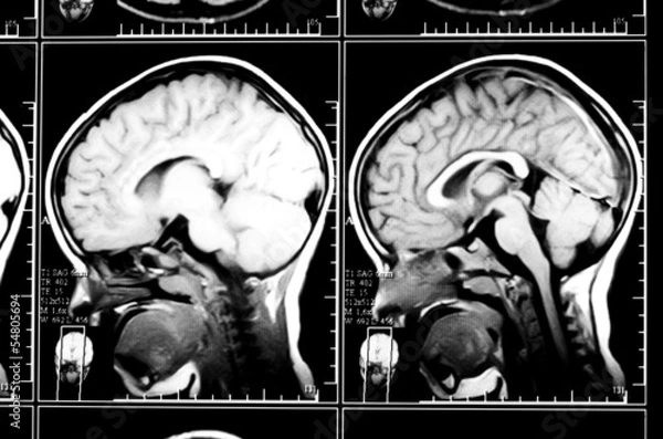 Fototapeta X-ray image of the brain computed tomography