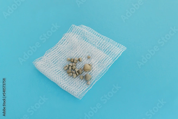 Obraz Gallbladder stones close up on a sterile napkin