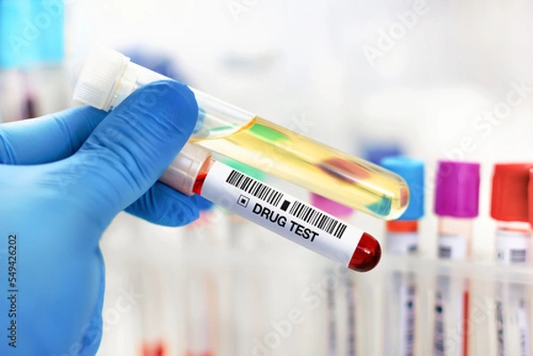 Fototapeta Hand doctor holding urine and blood tube test for analysis for doping or drugs. Doctor's hand with urinalysis and blood sample for drug test or alcohol in the laboratory