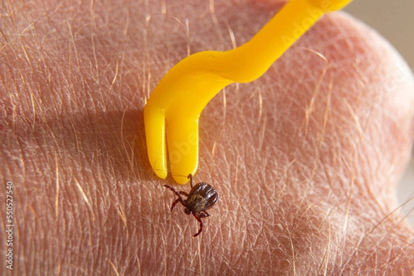 Fototapeta Removing a stuck tick from human skin. macro photography.