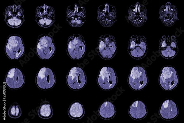 Fototapeta MRI Brain Axial views .to evaluate brain tumor. Glioblastoma, brain metastasis isodensity mass with an ill-defined margin and surrounding edema at the right frontal lobe.