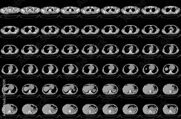 Obraz CT scan abdomen of the patient's Diffuse bronchial wall thickening and mild peribronchial infiltration at the superior segment of both lower lobes, Bone destruction at the vertebral body.