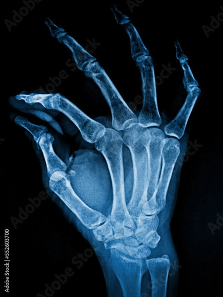 Fototapeta X-ray adult's hand bone 