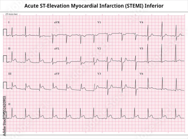 Fototapeta Acute ST-Elevation Myocardial Infarction (STEMI) Inferior - ECG Paper 12 Lead