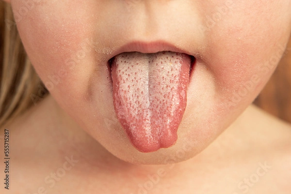 Obraz Strawberry tongue of a small child with scarlet fever caused by group A streptococcus