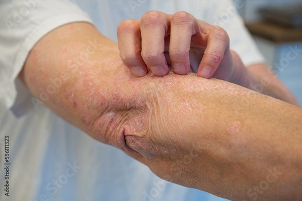 Fototapeta Itchy psoriasis on arm and hand