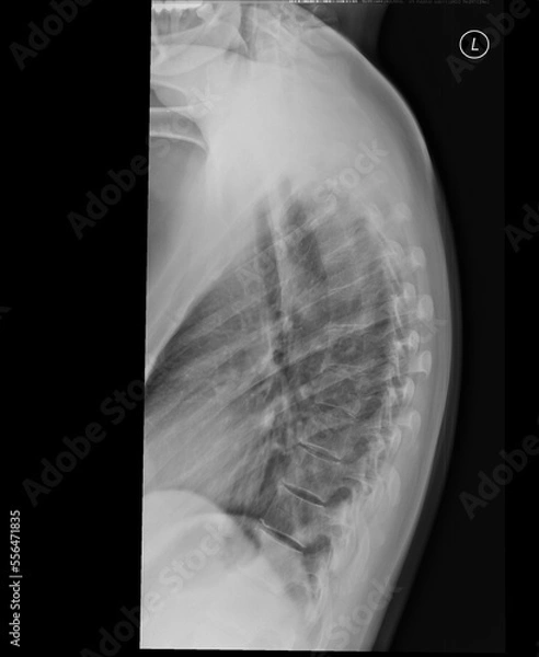Obraz Thoracic spine x-ray. Lateral view. A kyphosis with mild right convex scoliosis around the thoracolumbar transition. Normal vertebral body configuration. Intervertebral spaces are unaffected.