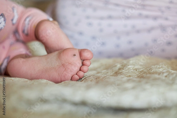 Fototapeta Close-up of a wart on a child's foot, a new wart is visible on the big toe..