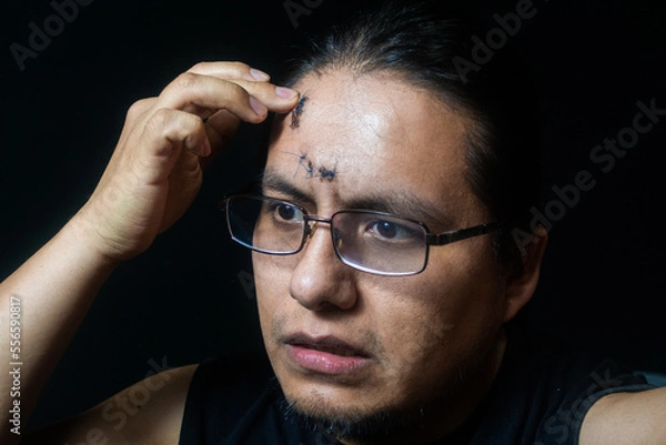 Obraz portrait of latino man with 6 stitches on his forehead, touching his wound, having a scared expression