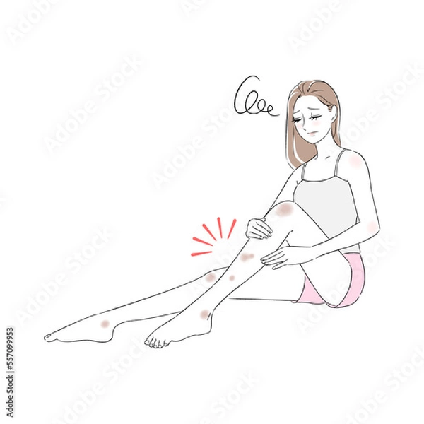 Fototapeta 女性　足　あざ　黒ずみ　シミ　美女　悩み　肌トラブル