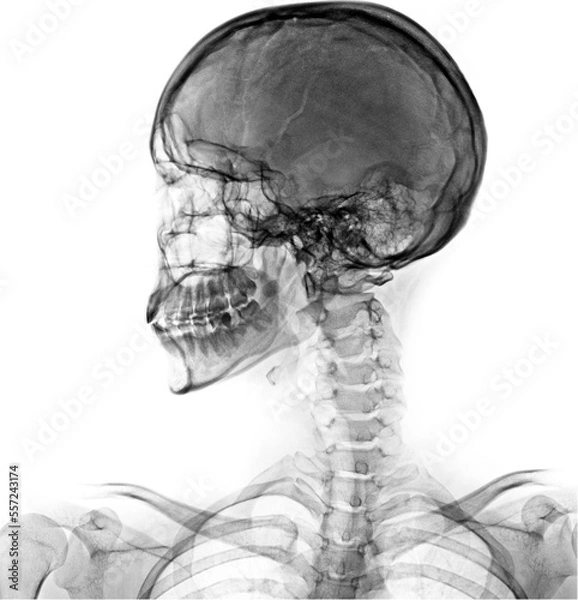 Obraz Skull lateral view x ray