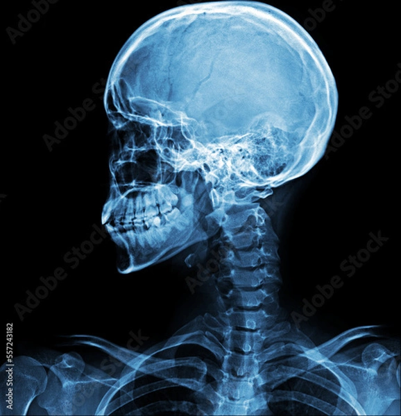 Obraz Skull lateral view x ray
