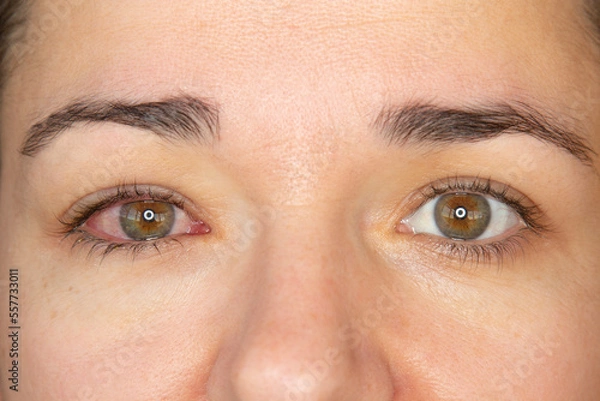 Obraz Close up of an adult woman having conjunctivitis, or pink eye caused by bacteria