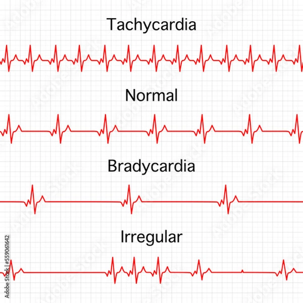 Obraz Heart rate graphics. Vector illustration. Electrocardiogram. illustration of medical electrocardiogram - ECG on chart paper. Tachycardia, normal, Bradycardia, Irregular heart beat.