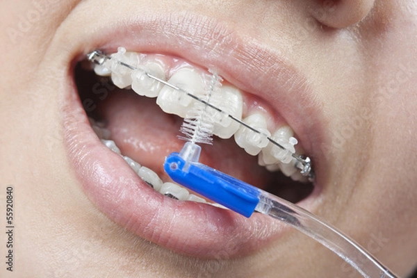 Obraz Brushing your teeth with braces