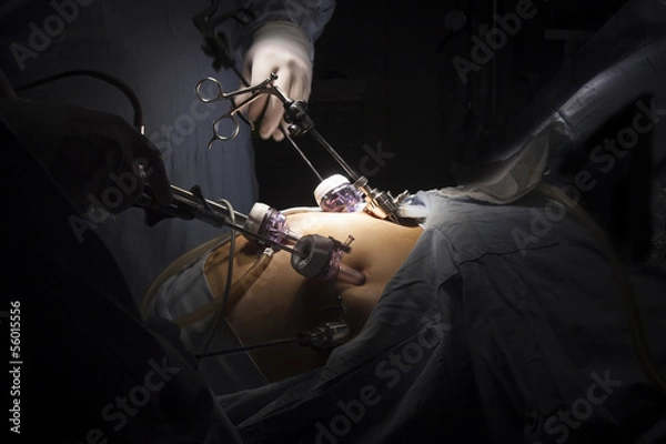 Obraz Gastric bypass surgery