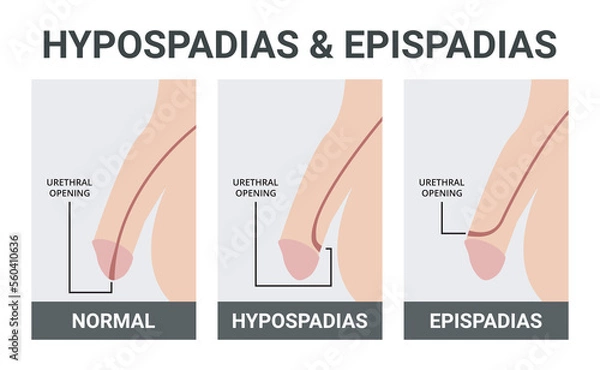 Fototapeta Hypospadias and Epispadias Medical Vector Illustration