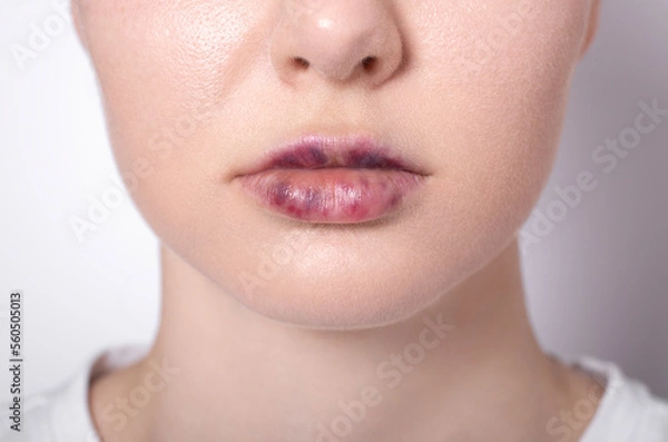 Obraz real women's bruised lips after lip augmentation injection of hyaluronic acid close-up, complications and hematomas after a beauty hyaluronan injection on female lips, contour lip plastic surgery