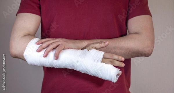 Fototapeta Broken arm, fingers. A white man in a red T-shirt with a cast on his arm.