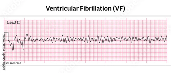 Fototapeta ECG Ventricular Fibrillation (VF) - 8 Second ECG Paper - Vector Medical Illustration