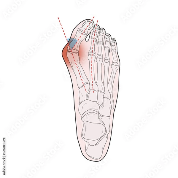 Obraz 무지외반증 해부학 메디컬일러스트