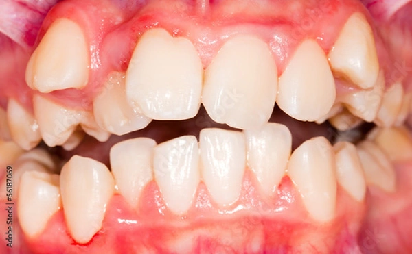 Obraz Dental displacement