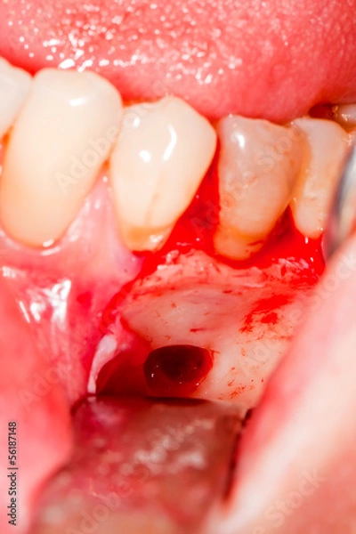 Obraz Surgical intervention