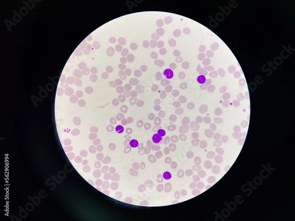 Fototapeta Chronic lymphocytic leukemia.