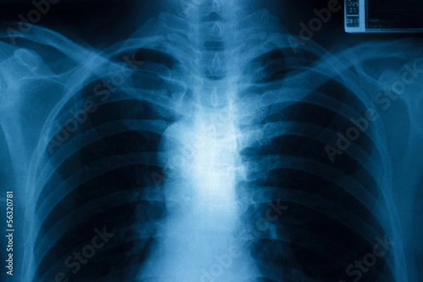 Obraz Chest x-ray