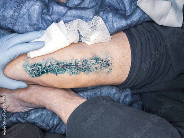 Fototapeta Wound after knee prosthesis operation exchange. Removing of  knee joint