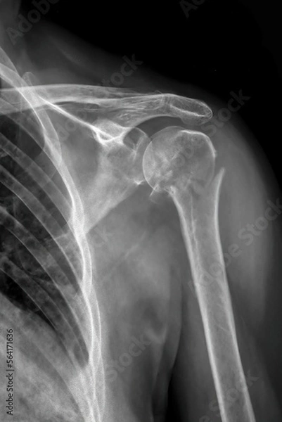 Fototapeta X-ray image of a broken shoulder bone, fracture neck of Humerus bone.