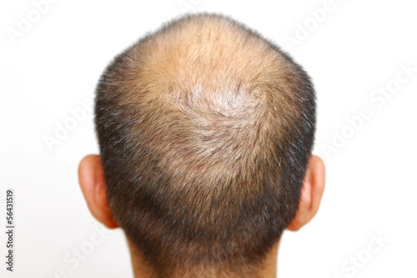 Fototapeta 薄毛の男性