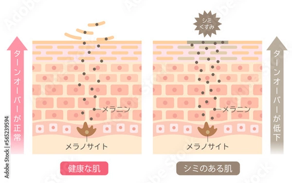 Obraz シミのできる肌のしくみ　ターンオーバー　肌細胞　ビフォアアフター