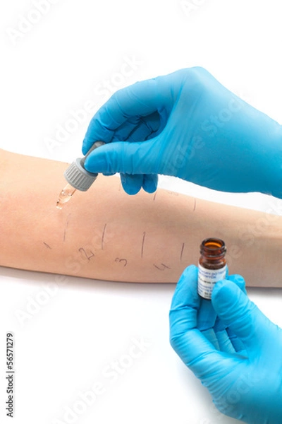 Fototapeta doing a skin prick allergy test