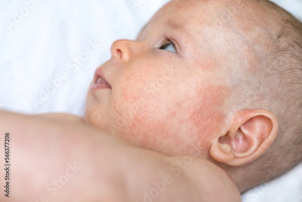 Fototapeta a baby boy face with red irritated marks near left ear and cheek, atopic dermatitis, blisters on sensitive skin in focus, a child laying on a white cloth with inflamed skin on his face, head, forehead