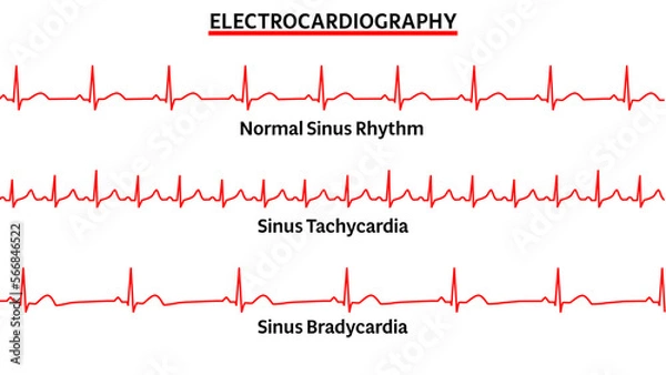 Fototapeta Set of ECG Common Abnormalities - Normal Sinus Rhythm - Sinus Tachycardia - Sinus Bradycardia - Vector Medical Illustration