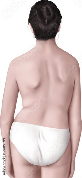 Obraz 척추측만증 여성 메디컬일러스트